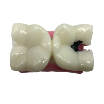 1pc zobni zob model zobozdravnik študija 6-Krat Karies Zob modeli Zobozdravnik poučevanje, Študij Raziskovanje zobozdravstvo zobozdravstvene izdelki