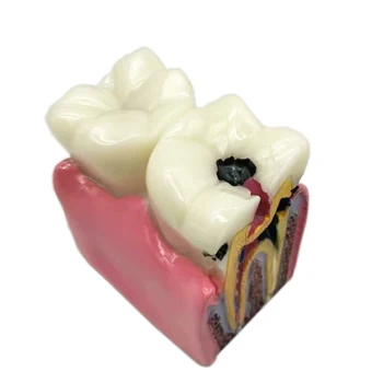 1pc zobni zob model zobozdravnik študija 6-Krat Karies Zob modeli Zobozdravnik poučevanje, Študij Raziskovanje zobozdravstvo zobozdravstvene izdelki